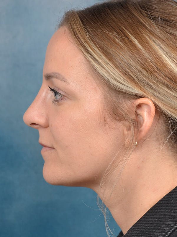 Rhinoplasty Before & After Gallery - Patient 146208719 - Image 2