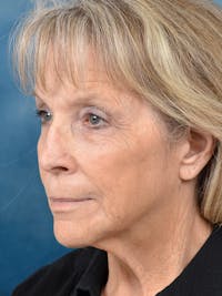 Deep Plane Facelift Before & After Gallery - Patient 146208584 - Image 1
