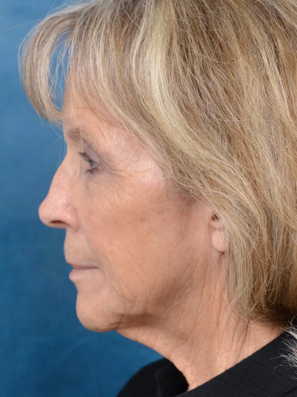 Lip Lift Before & After Gallery - Patient 146208695 - Image 9