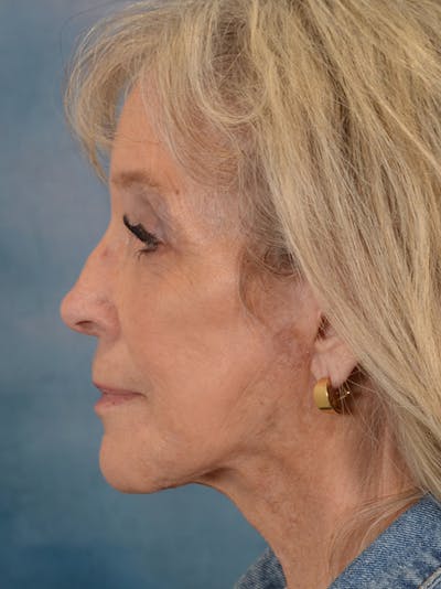 Deep Plane Facelift Before & After Gallery - Patient 146208584 - Image 10