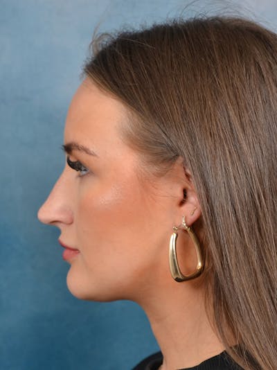 Rhinoplasty Before & After Gallery - Patient 146804355 - Image 1