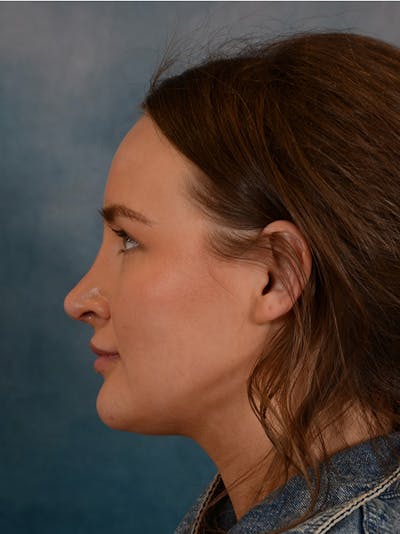 Rhinoplasty Before & After Gallery - Patient 146804355 - Image 2