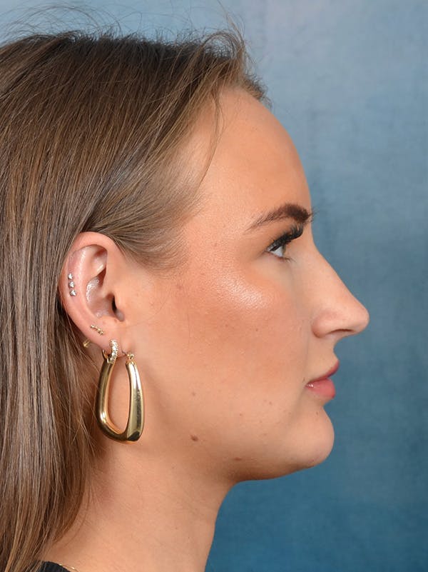 Rhinoplasty Before & After Gallery - Patient 146804355 - Image 9