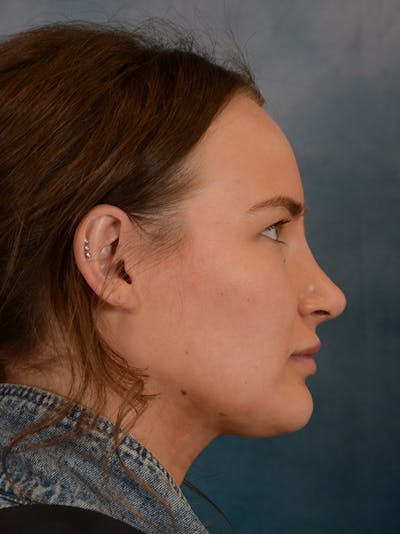 Rhinoplasty Before & After Gallery - Patient 146804355 - Image 10