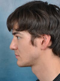 Rhinoplasty Before & After Gallery - Patient 148071969 - Image 1
