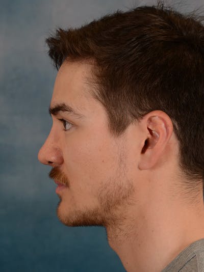 Rhinoplasty Before & After Gallery - Patient 148071969 - Image 2