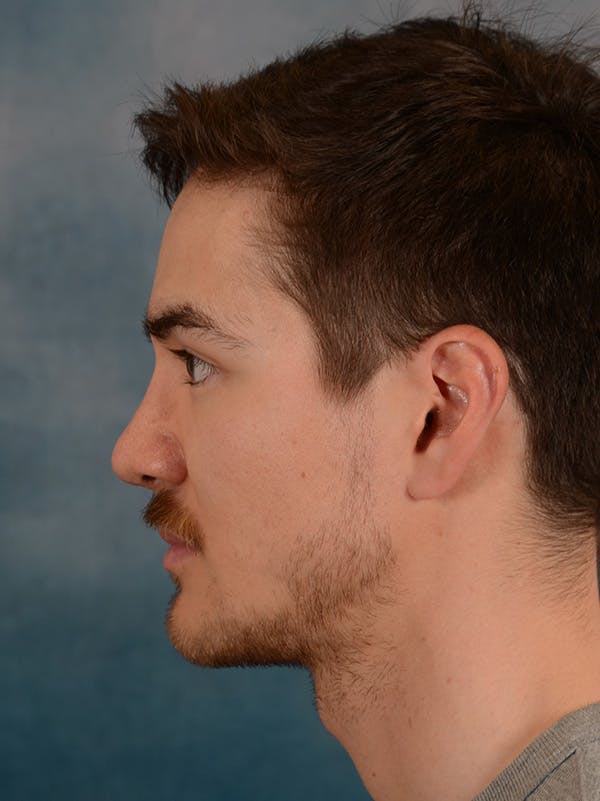 Rhinoplasty Before & After Gallery - Patient 148071969 - Image 2