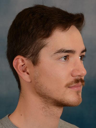 Rhinoplasty Before & After Gallery - Patient 146208709 - Image 8
