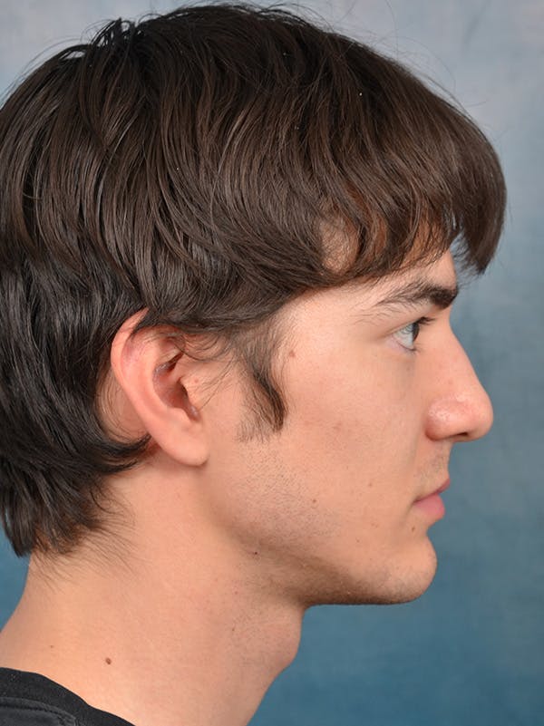 Rhinoplasty Before & After Gallery - Patient 146208709 - Image 9