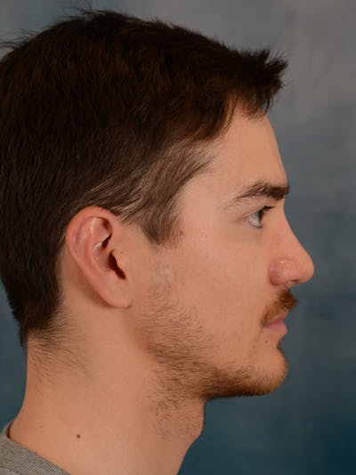 Rhinoplasty Before & After Gallery - Patient 148071969 - Image 10
