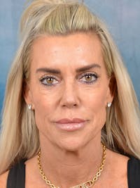 Laser Skin Resurfacing Before & After Gallery - Patient 146898907 - Image 1