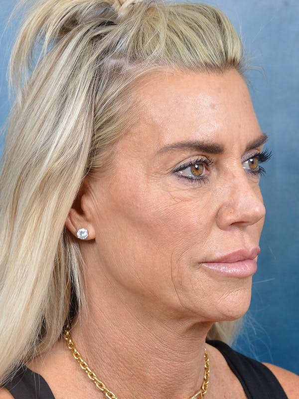Brow Lift Before & After Gallery - Patient 148072051 - Image 7