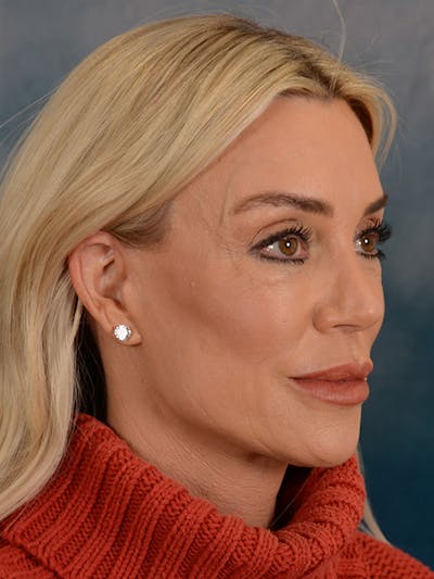 Brow Lift Before & After Gallery - Patient 148072051 - Image 8