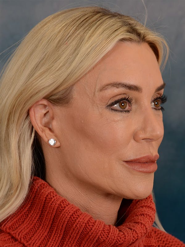 Brow Lift Before & After Gallery - Patient 148072051 - Image 8