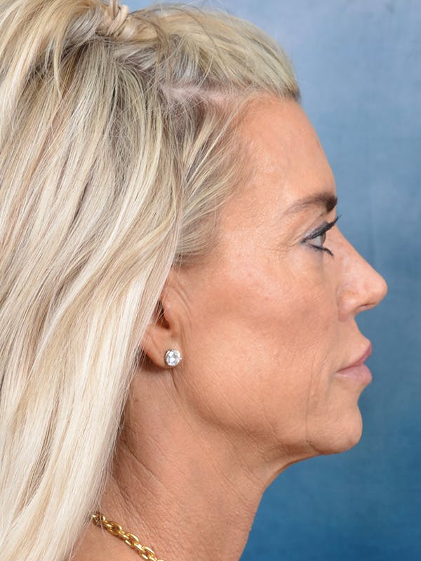 Brow Lift Before & After Gallery - Patient 146898882 - Image 9