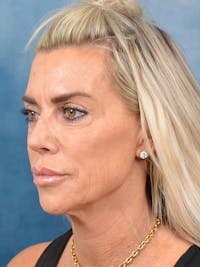 Deep Plane Facelift Before & After Gallery - Patient 146899001 - Image 1