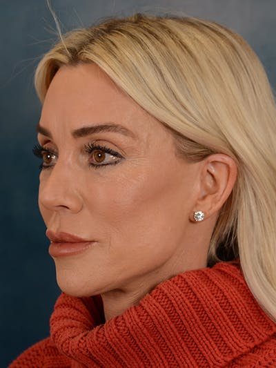Brow Lift Before & After Gallery - Patient 148072051 - Image 4