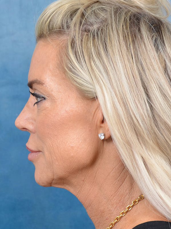 Brow Lift Before & After Gallery - Patient 148072051 - Image 5