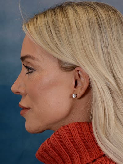 Brow Lift Before & After Gallery - Patient 148072051 - Image 6