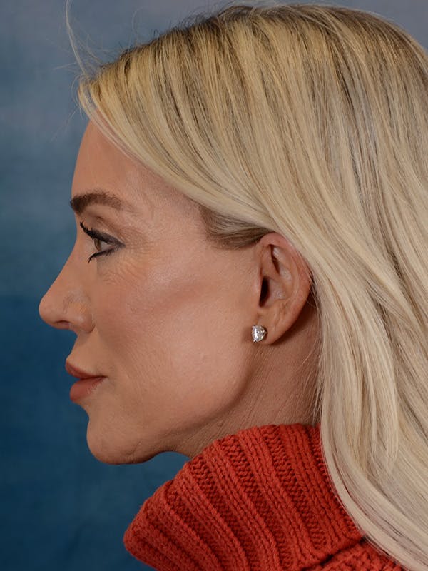 Brow Lift Before & After Gallery - Patient 148072051 - Image 6