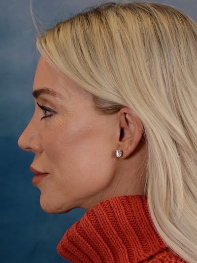 Deep Plane Facelift Before & After Gallery - Patient 146899001 - Image 4