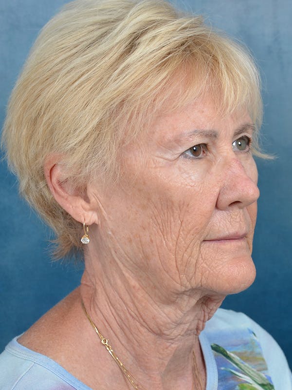 Deep Plane Facelift Before & After Gallery - Patient 146899105 - Image 5