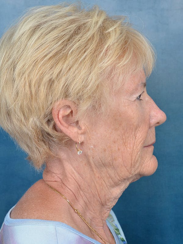 Deep Plane Facelift Before & After Gallery - Patient 146899105 - Image 7