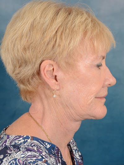 Deep Plane Facelift Before & After Gallery - Patient 146899105 - Image 8