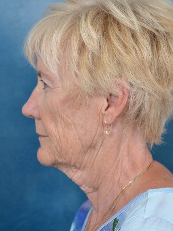 Laser Skin Resurfacing Before & After Gallery - Patient 146899007 - Image 9