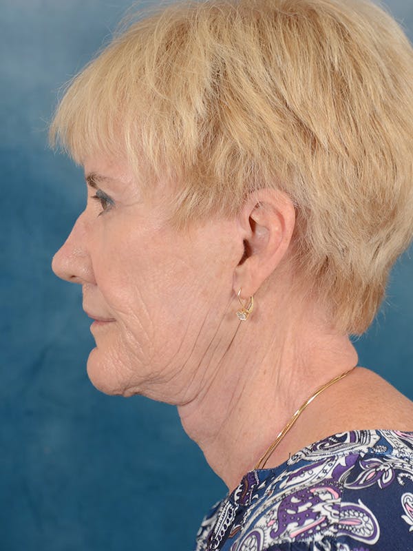 Laser Skin Resurfacing Before & After Gallery - Patient 146899007 - Image 10