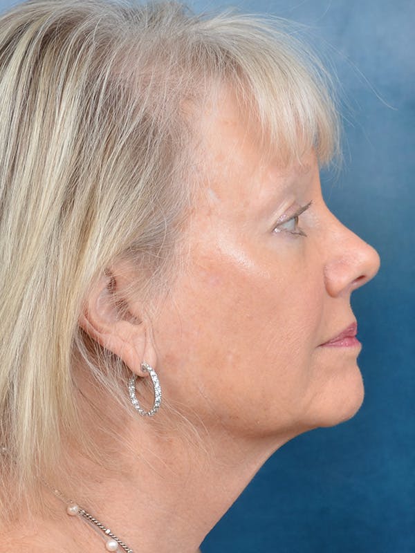 Laser Skin Resurfacing Before & After Gallery - Patient 146899109 - Image 7