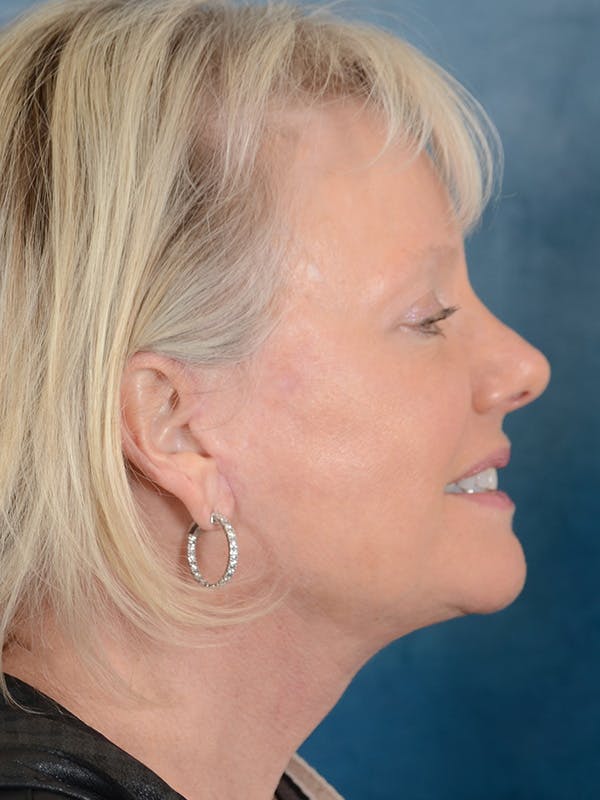 Laser Skin Resurfacing Before & After Gallery - Patient 146899109 - Image 8