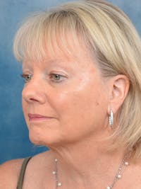 Deep Plane Facelift Before & After Gallery - Patient 146899123 - Image 1