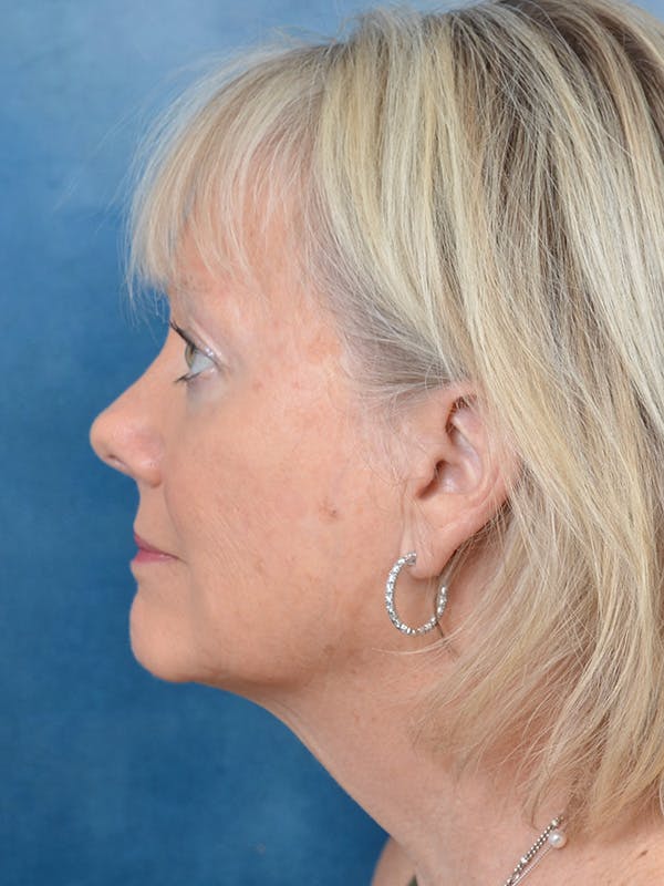 Deep Plane Facelift Before & After Gallery - Patient 146899123 - Image 9
