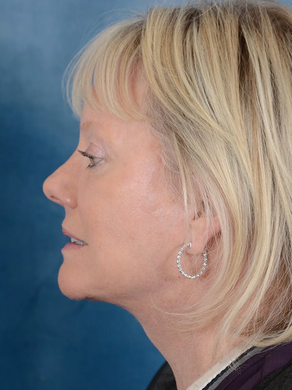 Laser Skin Resurfacing Before & After Gallery - Patient 146899109 - Image 10