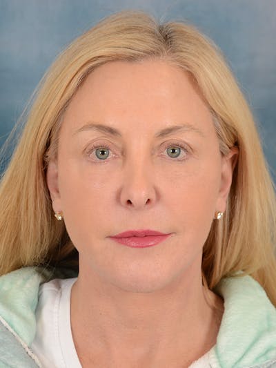 Deep Plane Facelift Before & After Gallery - Patient 146208727 - Image 4