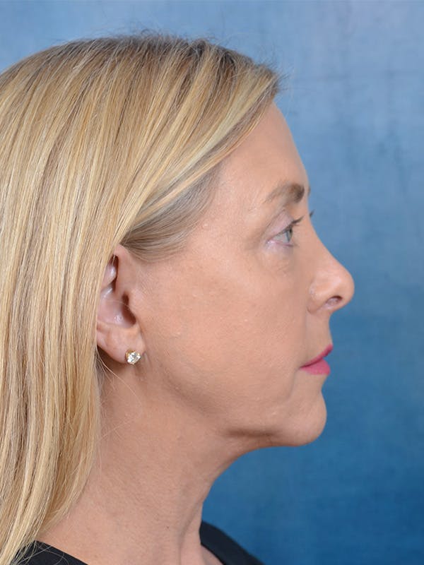 Deep Plane Facelift Before & After Gallery - Patient 148072000 - Image 7