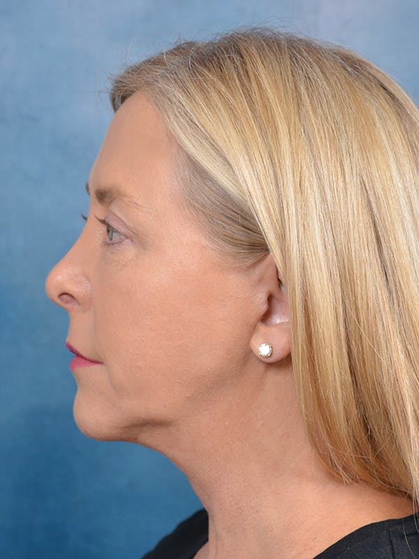 Deep Plane Facelift Before & After Gallery - Patient 146208727 - Image 9