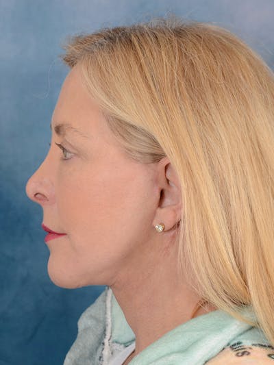 Deep Plane Facelift Before & After Gallery - Patient 146208727 - Image 10