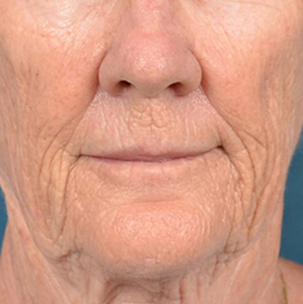 Lip Lift Before & After Gallery - Patient 146899006 - Image 1