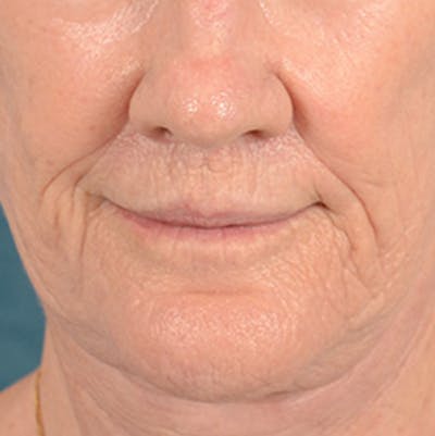 Lip Lift Before & After Gallery - Patient 146899006 - Image 2