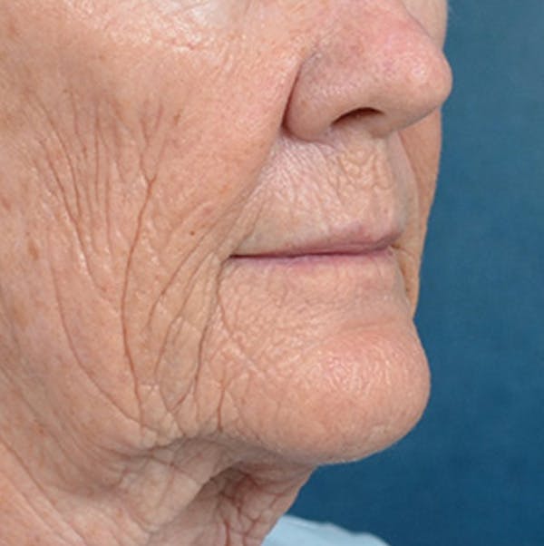 Lip Lift Before & After Gallery - Patient 146899006 - Image 3