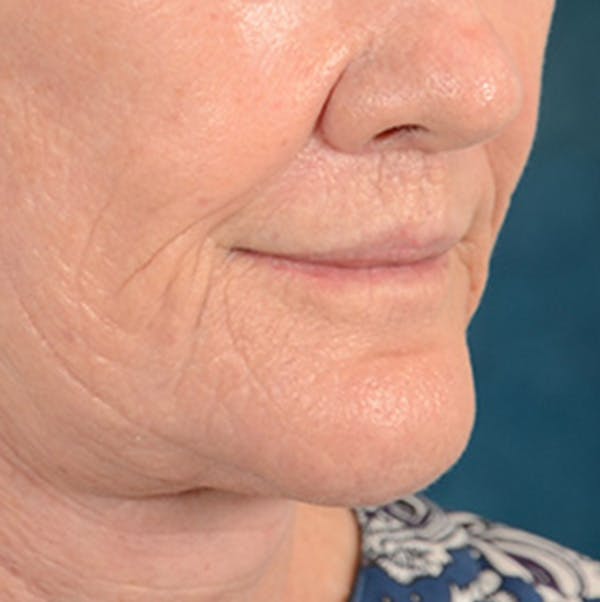 Lip Lift Before & After Gallery - Patient 146899006 - Image 4