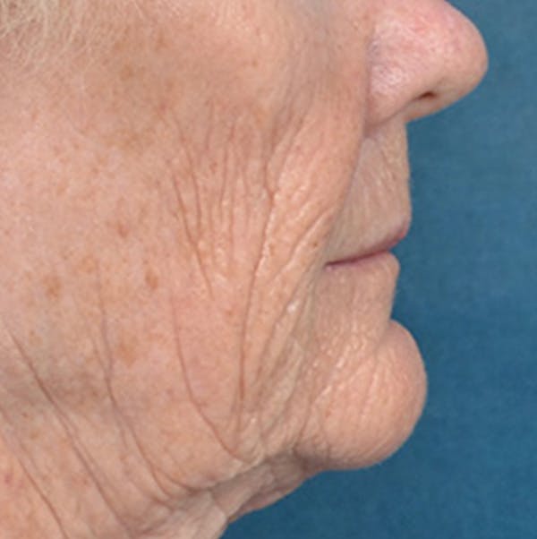 Lip Lift Before & After Gallery - Patient 146899006 - Image 5