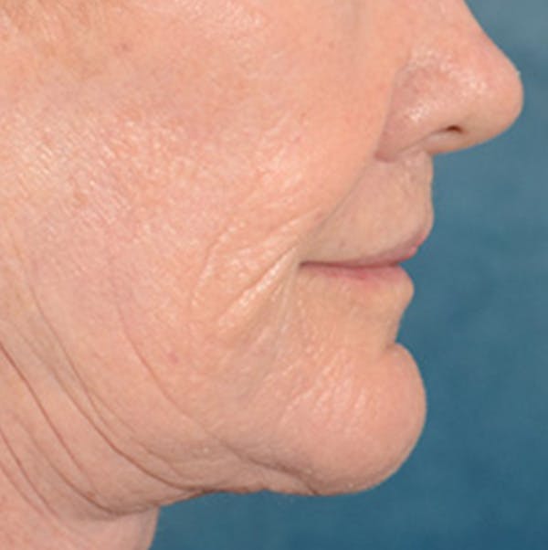 Lip Lift Before & After Gallery - Patient 146899006 - Image 6