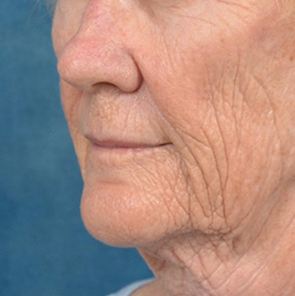 Lip Lift Before & After Gallery - Patient 146899006 - Image 7