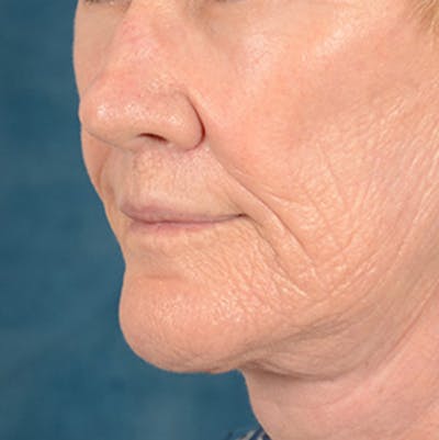 Lip Lift Before & After Gallery - Patient 146899006 - Image 8