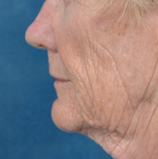 Lip Lift Before & After Gallery - Patient 146899006 - Image 9