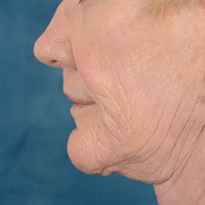 Lip Lift Before & After Gallery - Patient 146899006 - Image 10