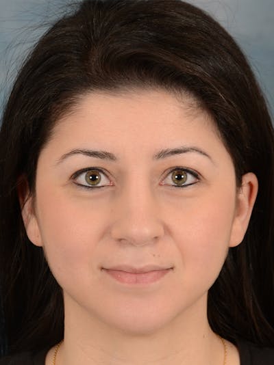 Rhinoplasty Before & After Gallery - Patient 148072003 - Image 6